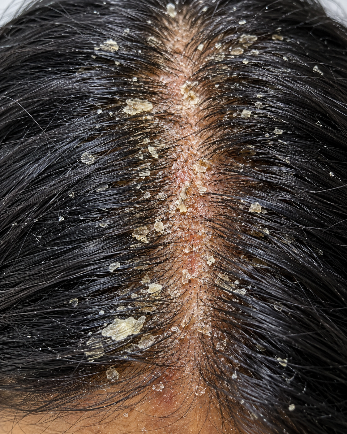 Dandruff After