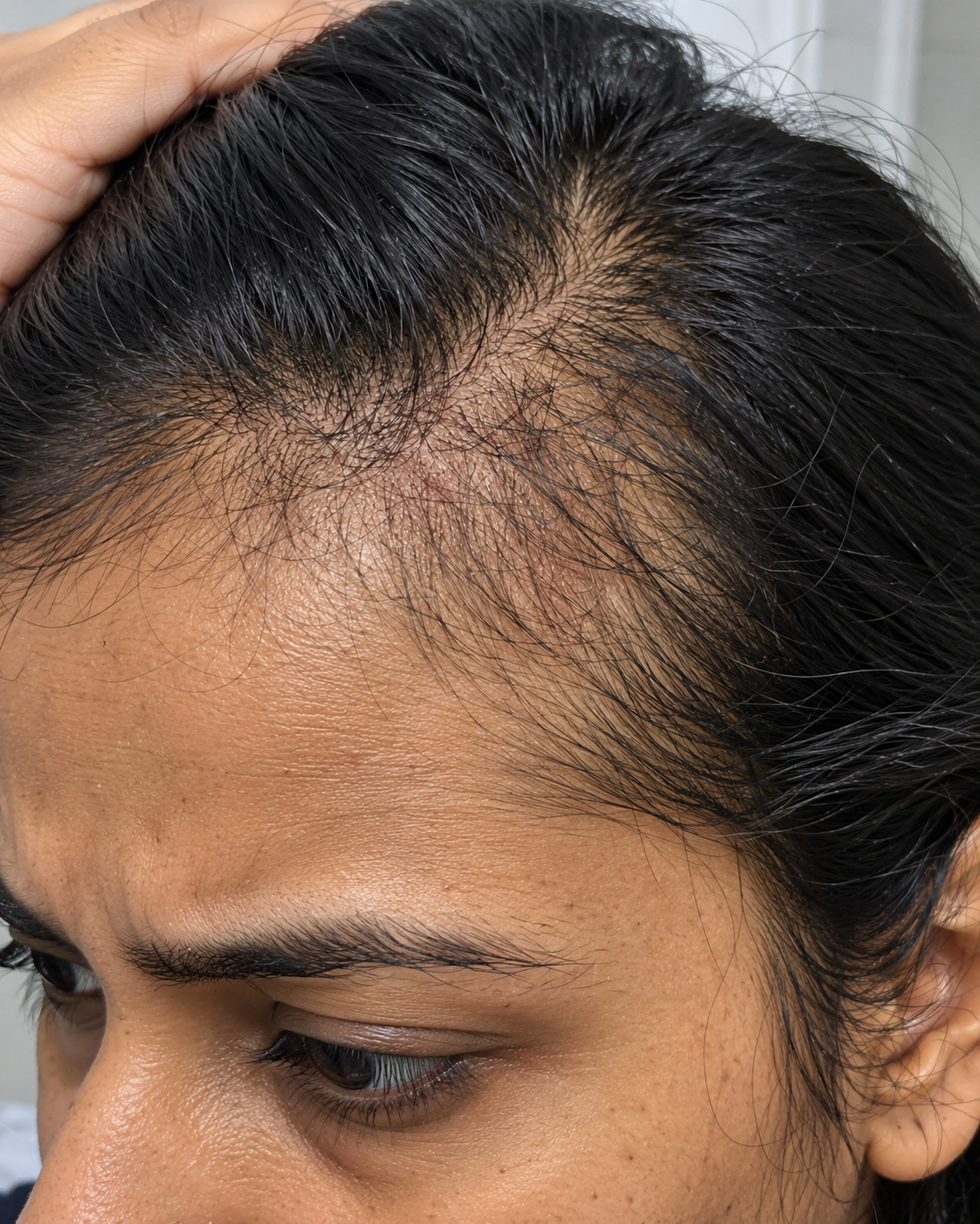 Hair Fall After